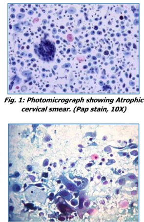 Fig. 2: Photomicrograph of cervical Pap smear  showing SCC. (Pap stain, 40X) 