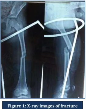 Figure 4: X-ray images of fracture mid shaft femur  of 9 year old boy: following implant removal 