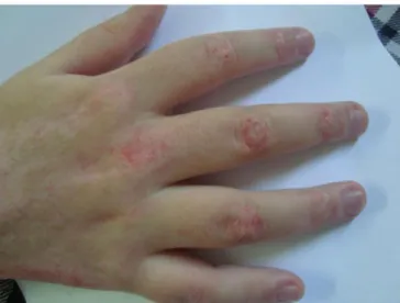 FIGURA 3:  Biopsia de pele à coloração de PAS demonstrando dermo-epidermite, padrão 