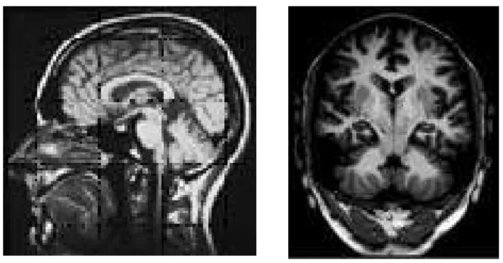 Fig. 2 - The historical MR record of head [11] (R. R. Ernst, 1985.). 