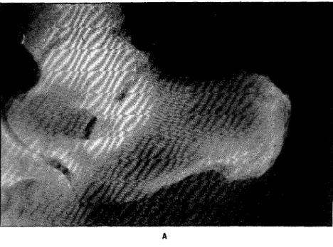 Fig. 4 — Calcificações das entesis (caso 6 - GC): 