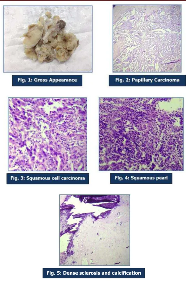 Fig. 5: Dense sclerosis and calcification