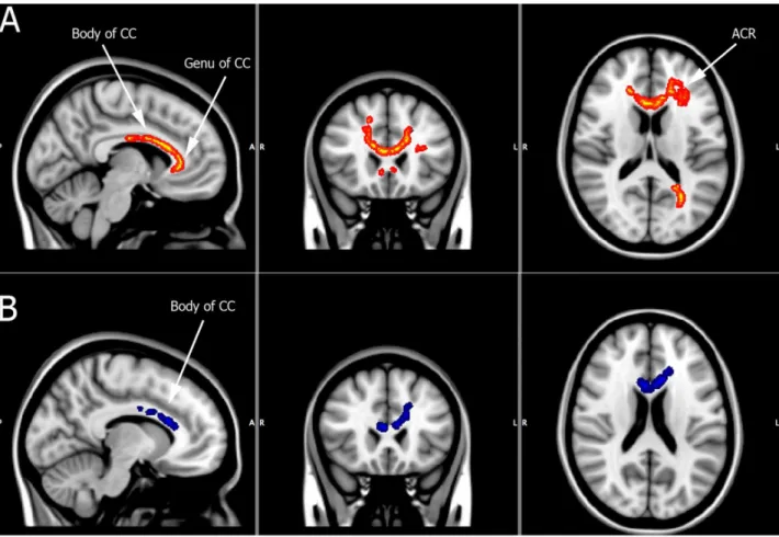 Figure 3. BD subgroup analysis. Panel A: Regions of significantly reduced FA for BDI patients (depicted in red/orange) compared to controls [CC = corpus callosum; ACR = anterior corona radiata]