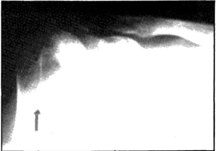 Fig. 2 — Subida da cabeça do úmero por rotura extensa da coifa dos rotadores 