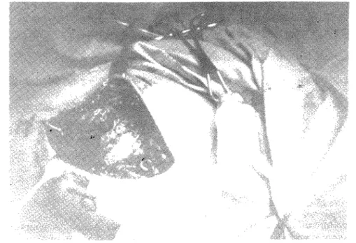 Fig. 5 — Visualização da cabeça do úmero em rotura intraoperatória 