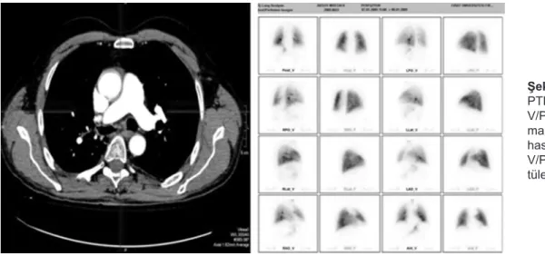 Şekil  4.  MDBT’de  PTE görülmeyen ve  V/P  sintigrafisi   nor-mal  değerlendirilen  hastanın  MDBT  ve  V/P sintigrafi  görün-tüleri TARTIŞMA