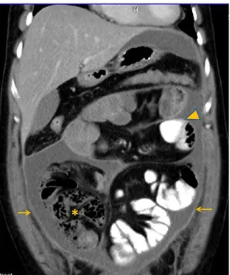 Figure 4: Photomicrograph showing areas of sclerosis (arrow  head)  with  foreign  body  giant  cells  (arrow) (Haematoxylin and eosin,    400)