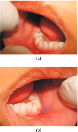 Fig. 3. (a)  Panoramic radiography,  (b) PA mandible  showing multilocular radiolucency with floating tooth 
