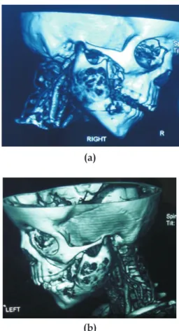 Fig. 4.  3D Computer tomography – right side  (a)  and left side  (b)  view of a 3D image showing 