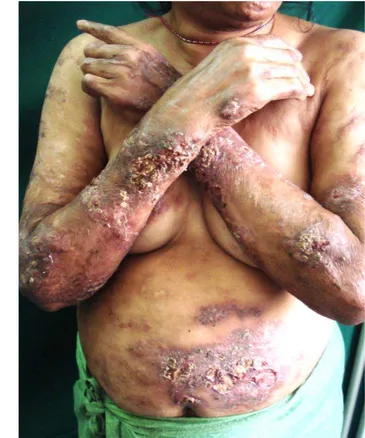 Figure 1. Clinical Photograph showing multiple  plaques with ulcerations over abdomen, forearms and  arms 