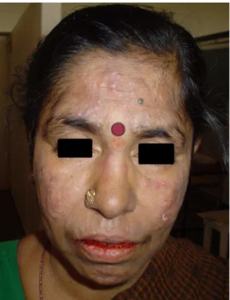 Figure 3. Clinical photograph showing pustules and      Figure 4. Clinical photograph showing scars and  