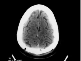 Figure 3. Postoperative CT of the brain. No residual tumor was found.