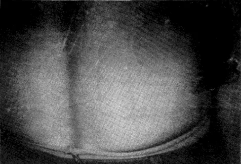 Figura 1 Fotografia da pele do dorso onde se visualiza um desenho em &#34;escrito&#34; pela passagem  suave da unha do observador