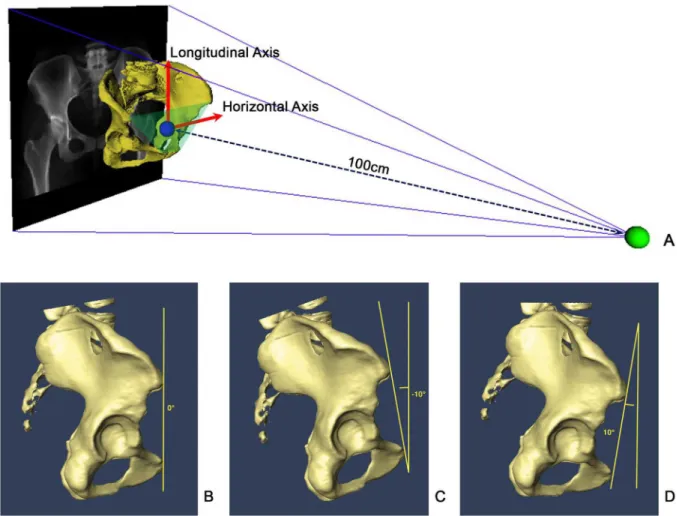 Fig 1. DRRs with different amounts of pelvic tilt. (A) Schematic view of DRR by controlling the projection parameters