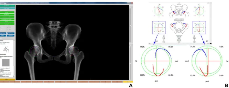 Fig 3. Hip 2 Norm Software. (A) Graphical user interface (left image) for digitizing landmarks for computerized evaluation of an AP radiograph of the pelvis.
