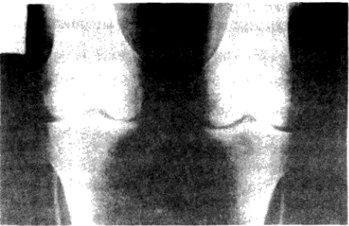 Fig. 5 — Osteoartrose do joelho: diminuição da entrelinha articular, esclerose sub-condral e  osteofitose marginal