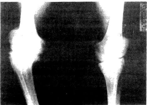 Fig. 6 — Artropatia Neuropática: marcadas alterações degenerativas e deformações osteo-arti- osteo-arti-culares
