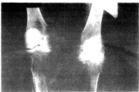 Fig. 8 — Artrite Reumatóide: grave compromisso articular bilateral. À esquerda, total desapa- desapa-recimento das cartilagens e múltiplas imagens erosivas