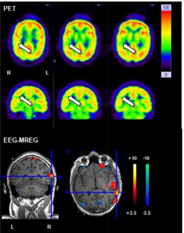 Fig 3. Example for correlation between PET and positive BOLD response. 26 year old patient (patient 2) with structural epilepsy