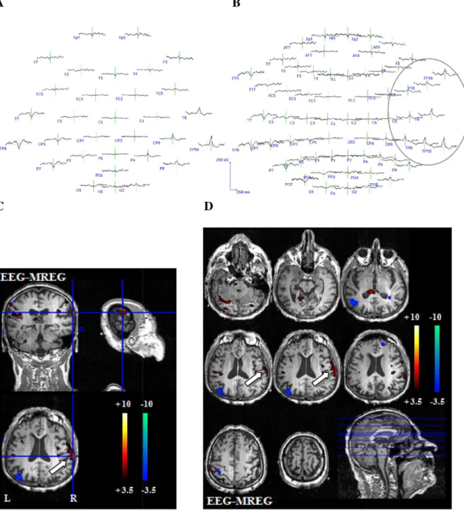 Fig 5. Example 2 for better representation of the BOLD-topography with 64 electrodes. 71-year-old patient (patient 10, study 3) with structural temporal lobe epilepsy