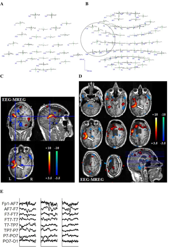 Fig 2. Example 1 for better representation of the BOLD-topography with 64 electrodes. 27-year-old patient (patient 6, study 3) with left structural frontal lobe epilepsy
