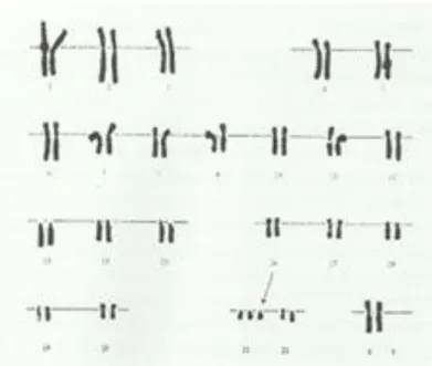 Figura 3: Cariótipo de cromossomas com trissomia 21 por não-disjunção. 