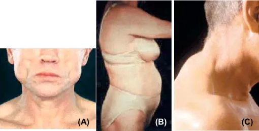 Figura 3. A. Paciente com lipoatrofia facial. B. Paciente com acúmulo de gordura em região  abdominal e hipertrofia de mamas