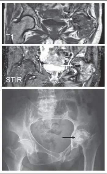 Abbildung 1:  MRI T1 und STIR untere Extremitäten: Knocheninfarkte in den Femura beiderseits und in der linken Tibia (Pfeile).
