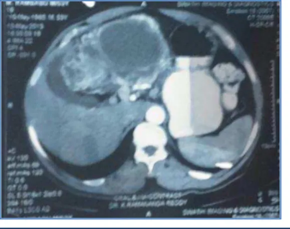 Fig. 1: Computed tomography scan showing  a large mass in the lesser omentum