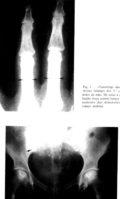 Fig. 1 — «Tunneling» das pri- pri-meiras falanges dos  3 . " e  4 . " 