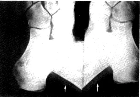 Fig. 5 Calcificações vasculares das artérias tibiais posteriortes (seta). 