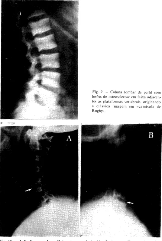 Fig. 9 — Coluna lombar de perfil com  lesões de osteosclerose em faixa  adjacen-tes às plataformas vertebrais, originando  a clássica imagem em «camisola de  Rugby»