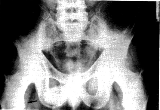Fig. 11 — Sacroiliaca fantasma à direita e reabsorção dos troquiteres femurais (seta)