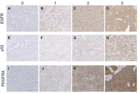 Figure 2. Algorithm used for the Classification of GBM cases into the different subtypes