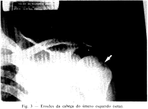 Fig. 3 — Erosões da cabeça do úmero esquerdo (seta). 