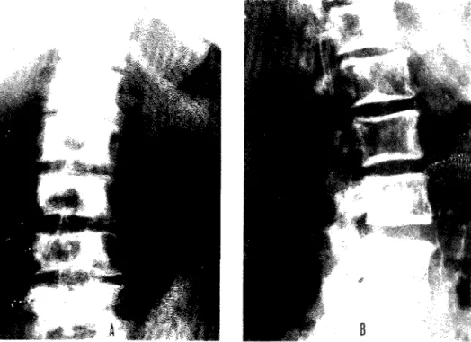 Fig. 4 Radiograma de frente de bacia e terço superior dos fémures. Lesão pagética do fémur  esquerdo que se apresenta muito hiperatrofiado em relação ao contralateral, e de parte da hemibacia  homolateral