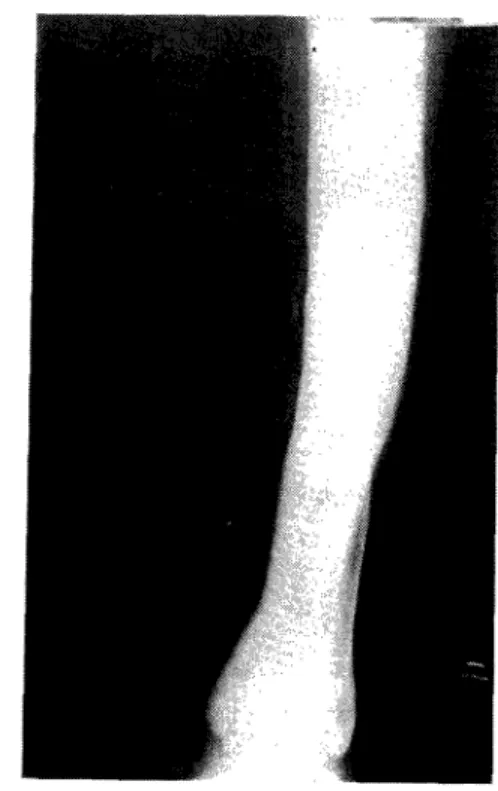 Fig. 10 —Radiograma da tíbia e perónio. Altera- Altera-ções pagéticas da tíbia e artéria tibial anterior com  calcificações