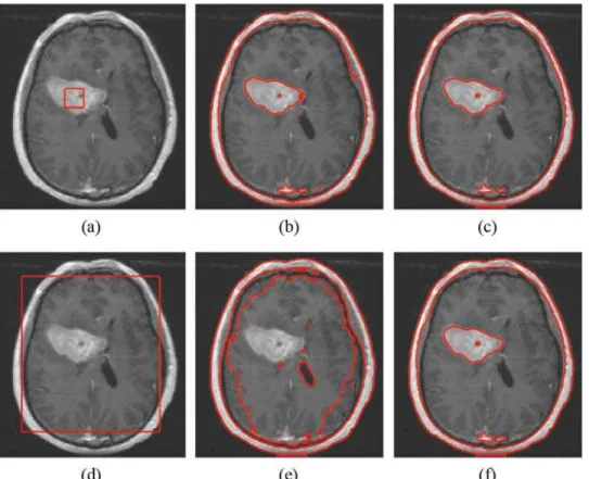 Fig 8. Comparisons of the segmentation results for a MR brain image contains tumor with intensity inhomogeneity between Li ’ s model and our model