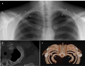 Figure 1. Posteroanterior lung radiography shows old fractures in bilateral irst ribs (arrows)(a), Transverse oblique reformatted CT image demonstrates old fracture  in let irst rib(b)