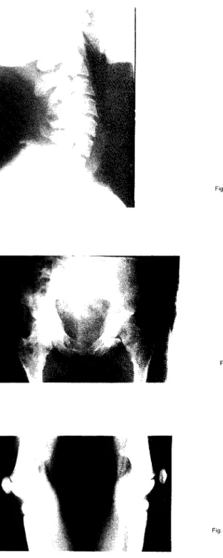 Fig. 6 —Exostoses das apófises espinhosas cervicais. 