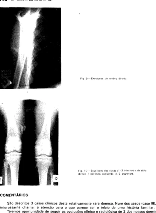 Fig 9 —Exostoses do ombro direito 