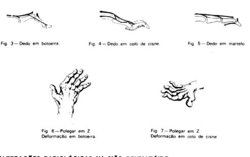 Fig. 6 —Polegar em Z Fig. 7—Polegar em 2  Deformação em botoeira. Deformação em colo de cisne 
