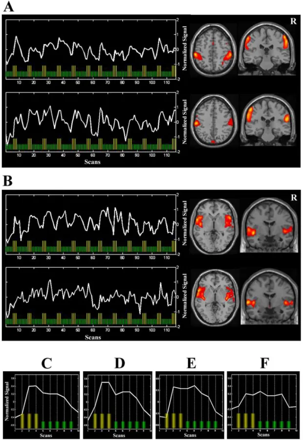 Figure 1. Temporal dynamics of the brain response to painful stimulation. (A) shows time courses and representative brain slices for the somatosensory component in fibromyalgia patients (top) and healthy subjects (bottom) derived from activation temporal a