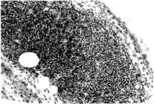 Fig 3 - Artrite reumatóide  com distribuição nodular 