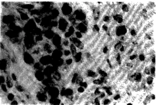 Fig. 5 (Sinovite da Artrite Reumatóide). Depósitos  IgG em plasmocitos 