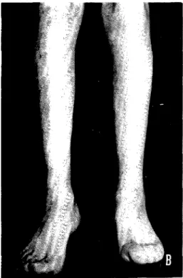 Fig 2 —Fotografia das pernas e pés de J.A.V., doente  do sexo masculino de 55 anos de idade Em Junho de  1985 (A) é bem visível o edema das duas pernas, posto  em evidência pelo sinal de godé (seta); de notar a 