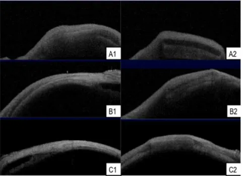 Figure 8. Serial AS-OCT thickness measurements of PLGA 50/50 and PLC70/30 microfilms in subconjunctival space.