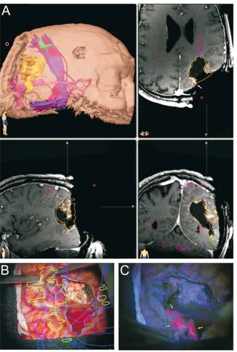 Figure 3. Dual intraoperative visualization approach and anatomical view. On the basis of a typical case of a tumor in the vicinity of an eloquent area, we demonstrate that the risk of missing tumor remnants covered by non-pathological tissue is eliminated