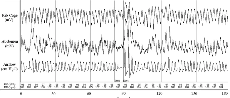 Figure 1: In this 180-second PSG recording, a 9-year-old female with an OA that led to significant cardiac variations when compared to the prior  tidal breathing baseline can be observed