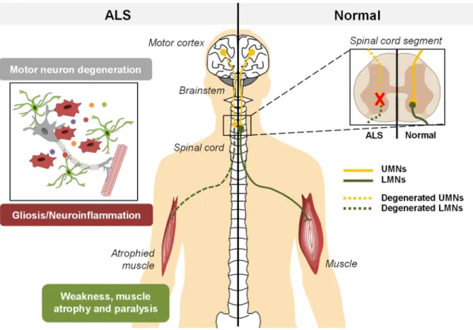 Figure  I.  4  –  ALS  is  a  neurodegenerative  disease,  resulting  from  the  degeneration  of  UMNs  and/or  LMNs